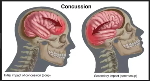 concussion.png